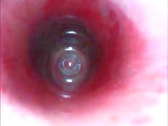Endoscope Photo Galery - Male Rectal Insertion